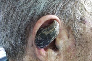 Why some humans grow horns