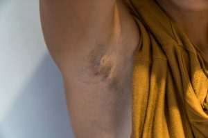 Hidradenitis suppurativa: the painful skin condition that can hide in plain sight